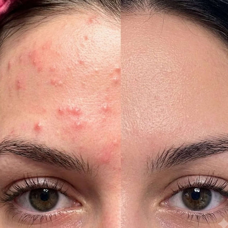Teen Acne 101: What's Actually Causing It (Hormones, Diet, or Products?)