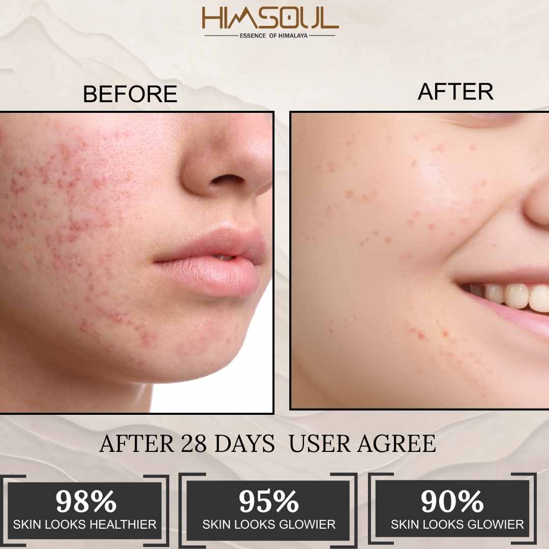 Anti Acne - Himsoul Enterprises