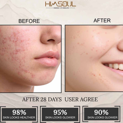 Anti-Acne Collection