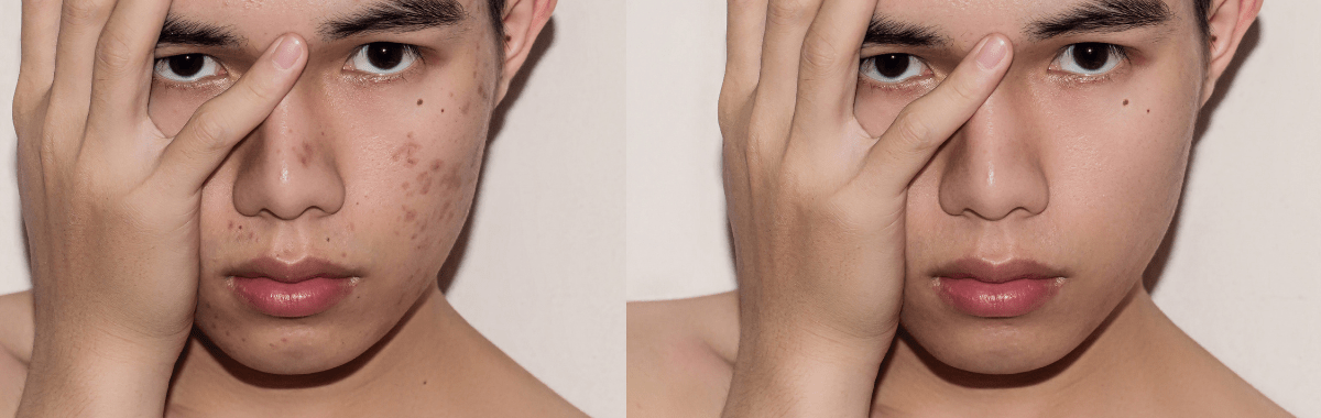 Teen Anti-Acne Routine: Face Wash, Serum & Cream