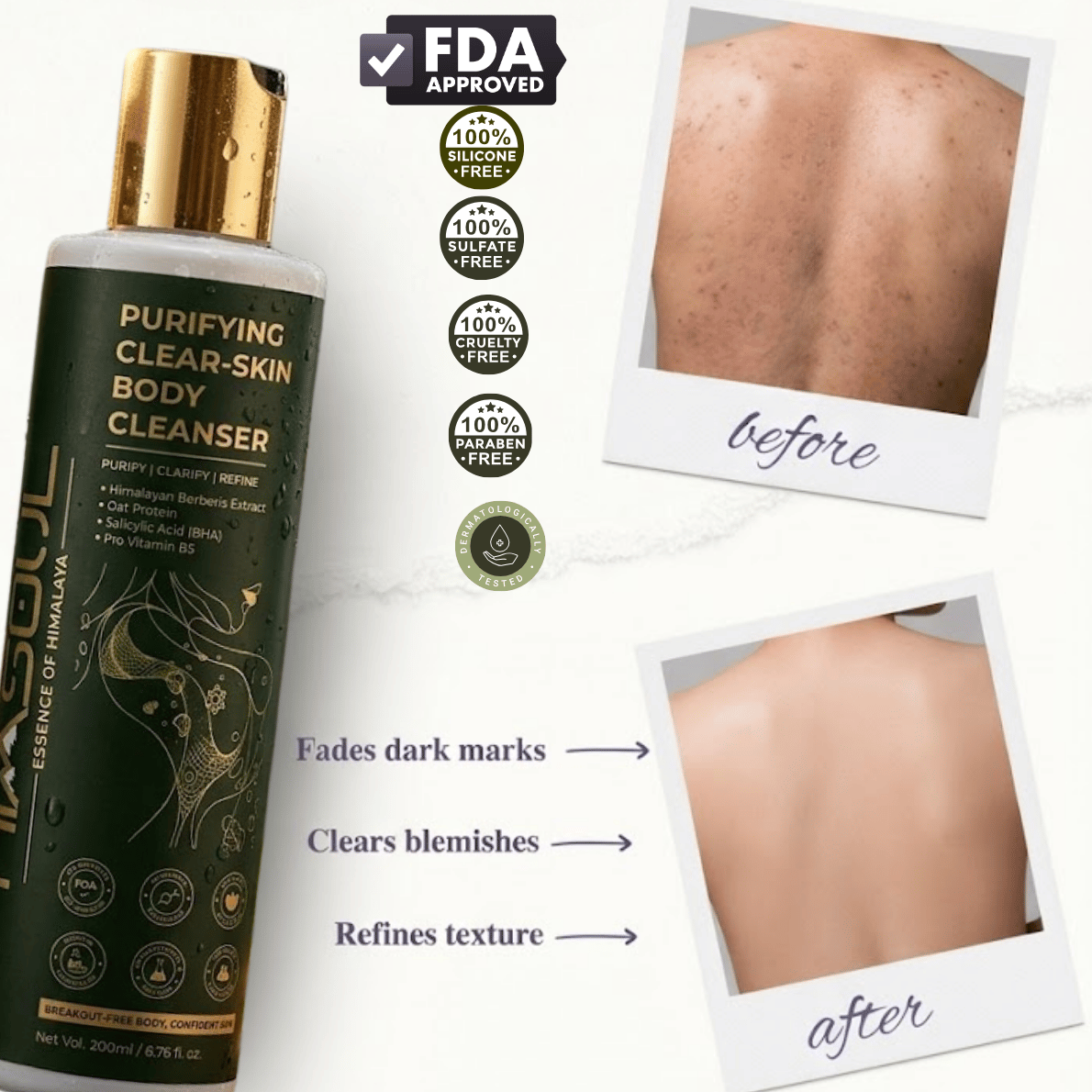 FDA approved and dermatologically tested Himsoul body wash before and after back acne treatment showing faded dark marks and smooth skin texture.