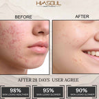 Himsoul Teen Clear Skin Duo – Oil Control Wash & Anti - Acne Cream (Ages 10+) - Himsoul Enterprises